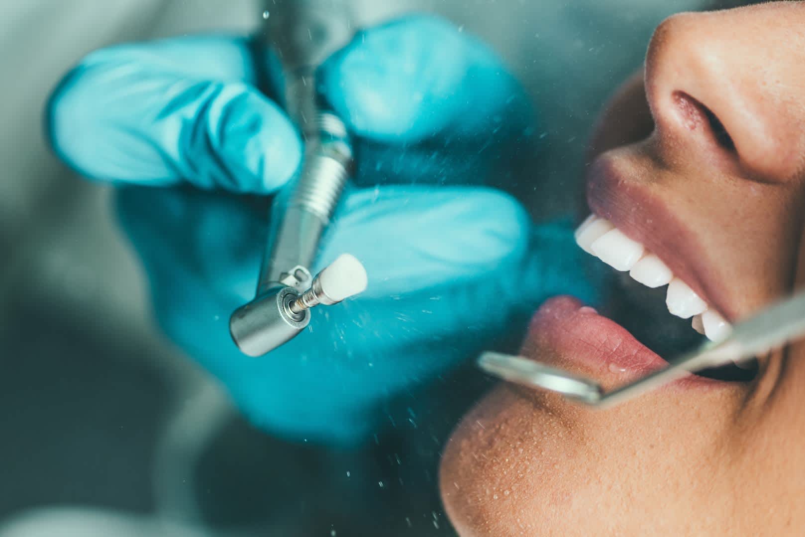 Professional teeth cleaning